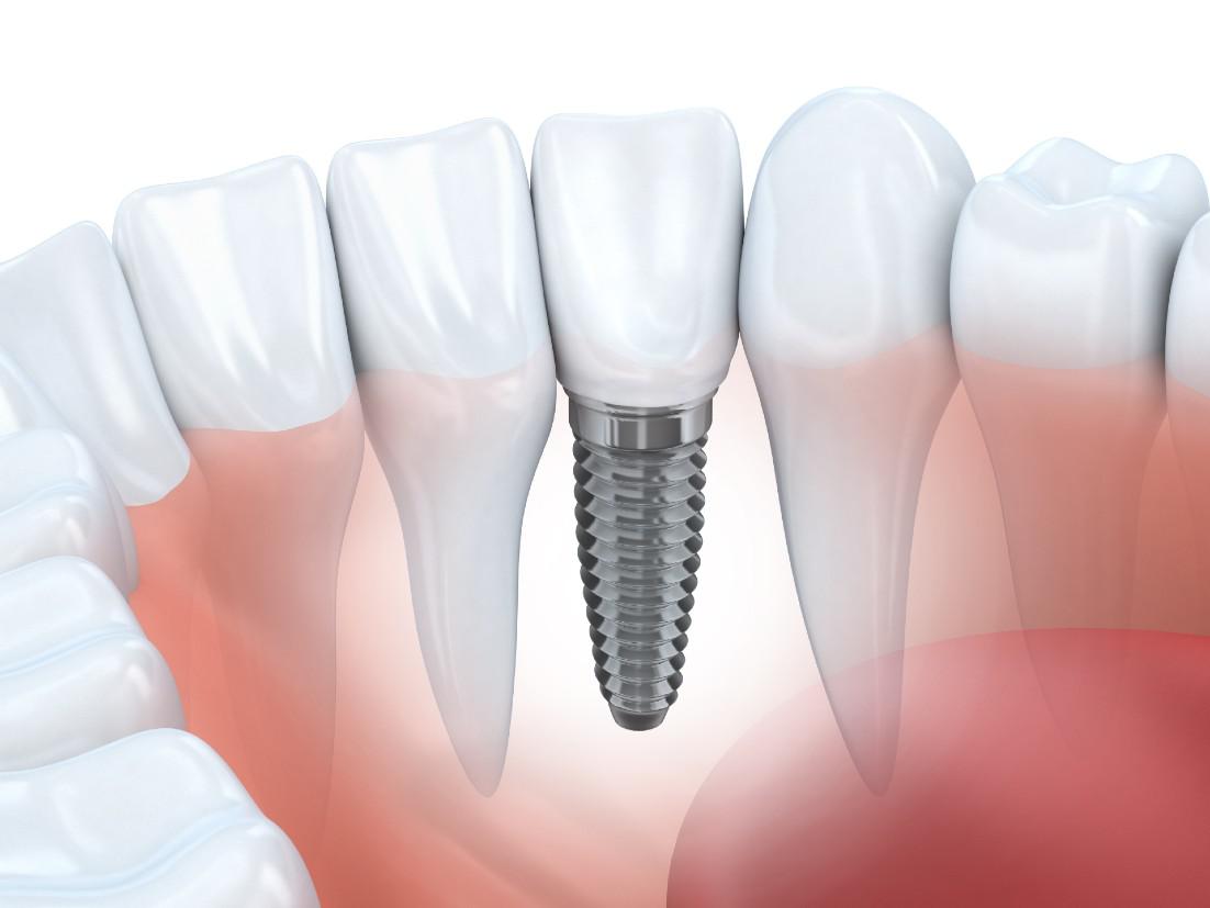 Dental Implants Vallejo, CA