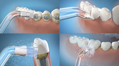 Waterpik for treatment of gum disease at Chaney Family Dental